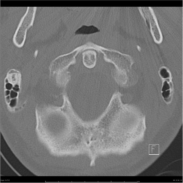 File:Bilateral cervical ribs (Radiopaedia 25868-26017 Axial bone window 6).jpg
