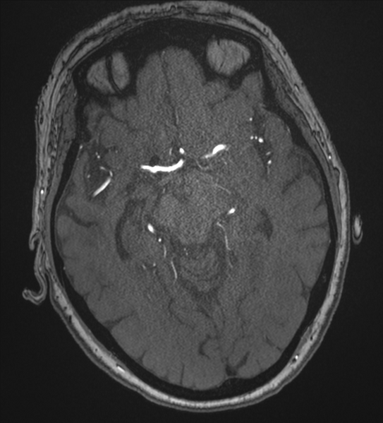 File:Bilateral fetal posterior communicating arteries (Radiopaedia 41286-44102 Axial MRA 90).png