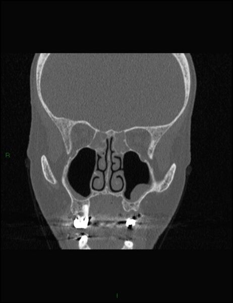 File:Bilateral frontal mucoceles (Radiopaedia 82352-96454 Coronal 156).jpg