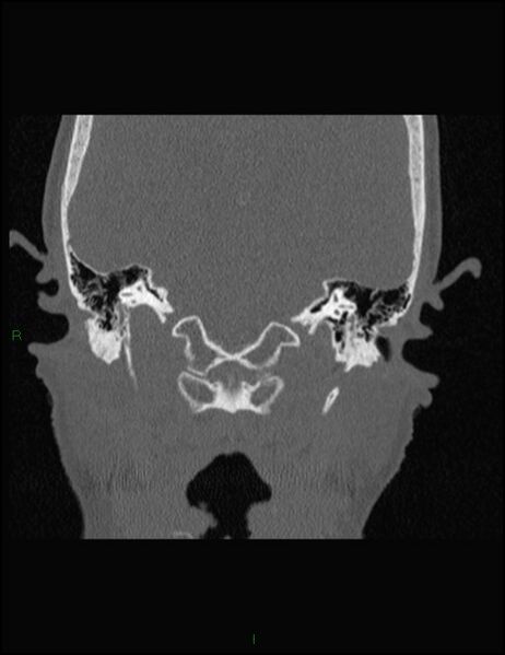 File:Bilateral frontal mucoceles (Radiopaedia 82352-96454 Coronal 318).jpg