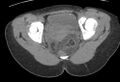 Bilateral mature cystic ovarian teratoma (Radiopaedia 88821-105592 Axial non-contrast 38).jpg
