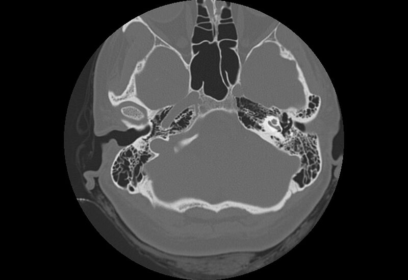 File:Bilateral otospongiosis (Radiopaedia 35447-36940 Axial bone window 21).jpg