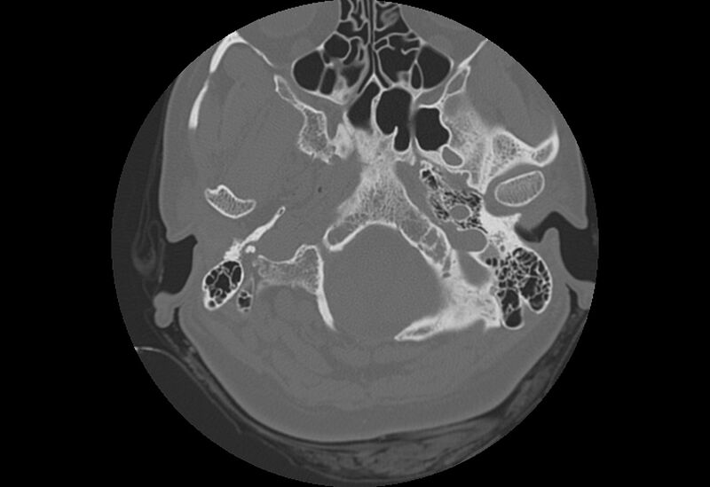 File:Bilateral otospongiosis (Radiopaedia 35447-36940 B 7).jpg