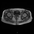 Bilateral ovarian fibroma (Radiopaedia 44568-48293 Axial T1 22).jpg