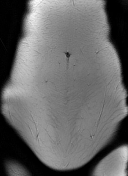 File:Bilateral ovarian fibrothecomas - adolescent (Radiopaedia 86604-102707 Coronal T2 3).jpg