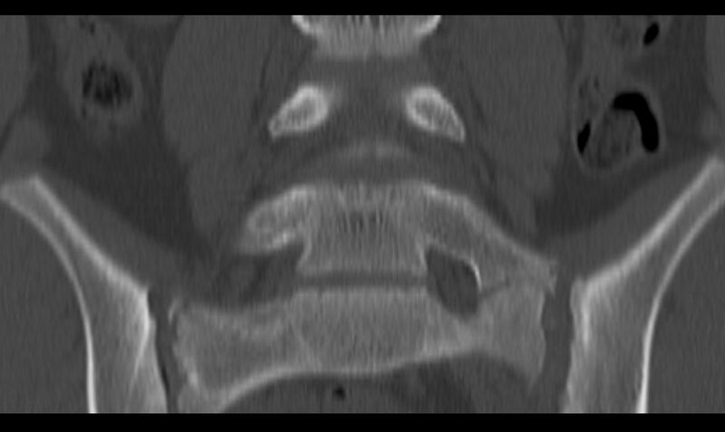 File:Bilateral pars defect (Radiopaedia 26691-26846 Coronal bone window 22).jpg