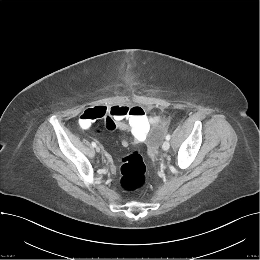 Bilateral psoas hematomas (Radiopaedia 24057-24279 A 73).jpg