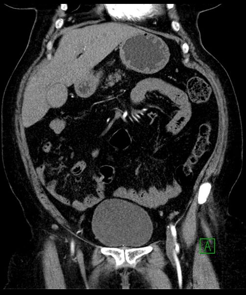File:Bilateral sporadic synchronous clear cell renal cell carcinoma (Radiopaedia 85035-100575 D 40).jpg