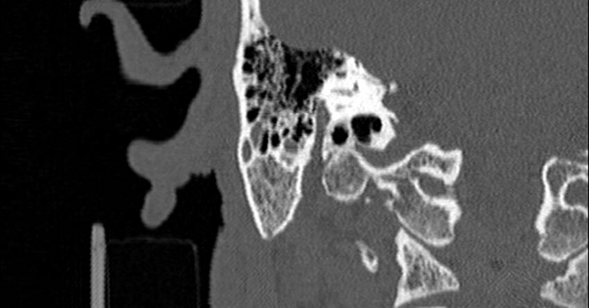 Bilateral temporal bone fractures (Radiopaedia 29482-29970 Coronal non-contrast 132).jpg