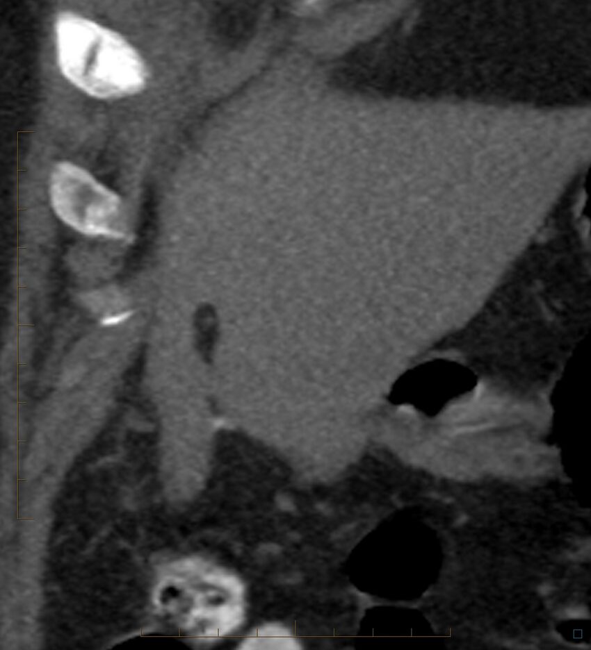 Bile leak from accessory duct(s) of Luschka post cholecystectomy (Radiopaedia 40736-43389 B 14).jpg