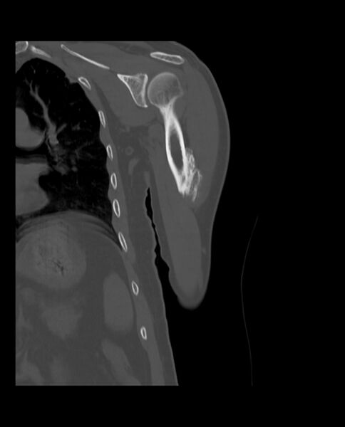 File:Bizarre parosteal osteochondromatous proliferation (Radiopaedia 84221-99501 Coronal bone window 13).jpg