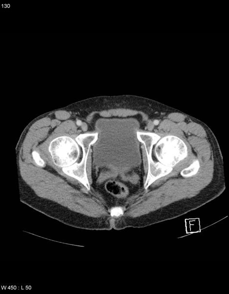 File:Boerhaave syndrome with tension pneumothorax (Radiopaedia 56794-63603 A 65).jpg