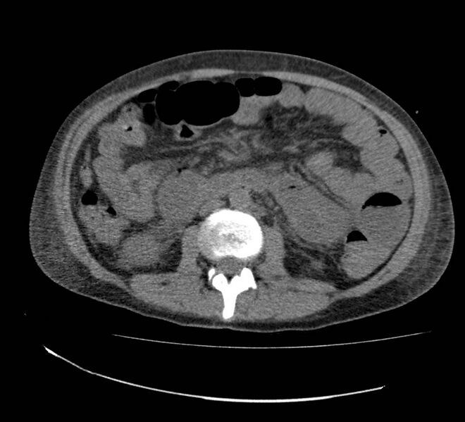 File:Bowel lymphoma complicated by bleeding after therapy (Radiopaedia 55601-62110 Axial non-contrast 40).jpg