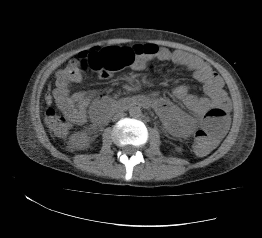 Bowel lymphoma complicated by bleeding after therapy (Radiopaedia 55601-62110 Axial non-contrast 40).jpg