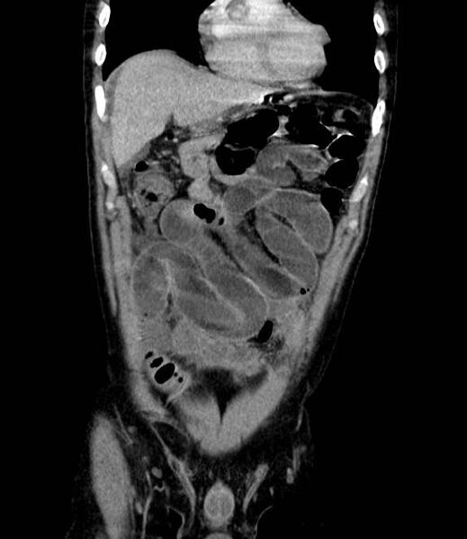 File:Bowel obstruction from colon carcinoma (Radiopaedia 22995-23028 C 17).jpg