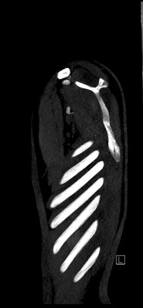 File:Brachiocephalic trunk pseudoaneurysm (Radiopaedia 70978-81191 C 90).jpg