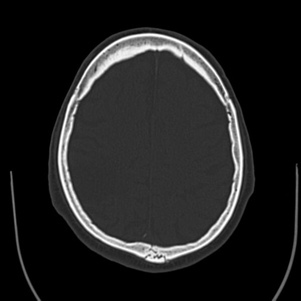 File:Brain Pantopaque remnants (Radiopaedia 78403-91048 Axial bone window 49).jpg