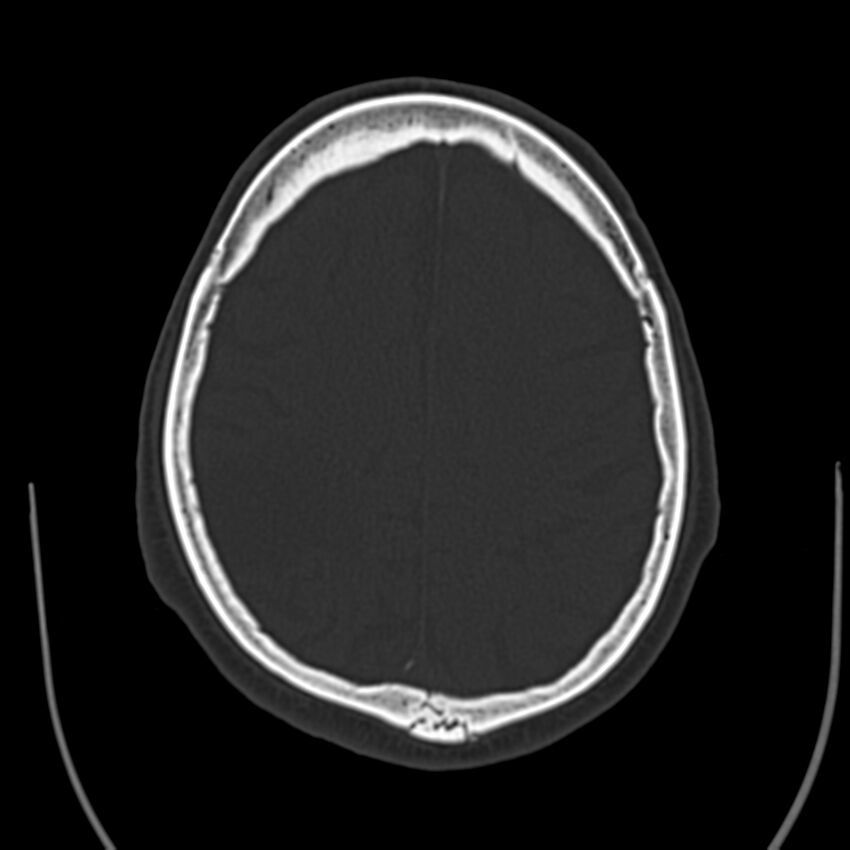 Brain Pantopaque remnants (Radiopaedia 78403-91048 Axial bone window 49).jpg