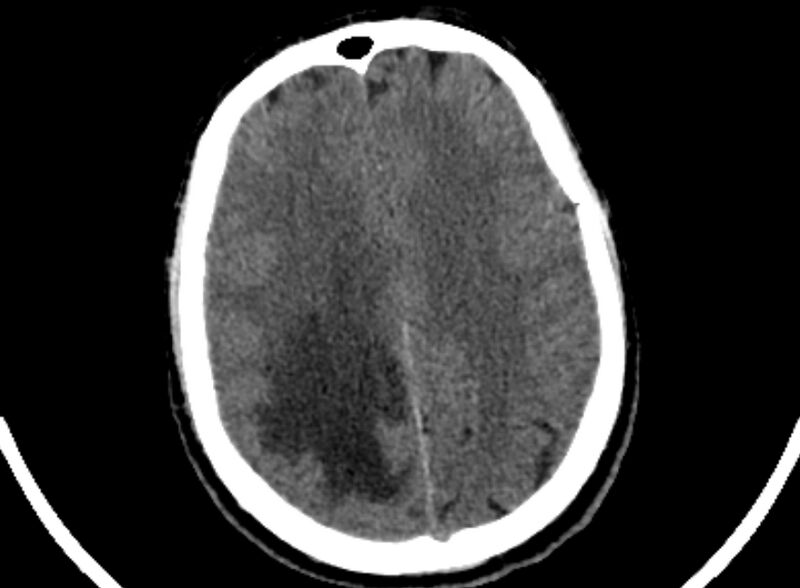 File:Brain abscess complicated by intraventricular rupture and ventriculitis (Radiopaedia 82434-96575 Axial non-contrast 81).jpg