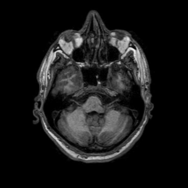 File:Brain abscess complicated by intraventricular rupture and ventriculitis (Radiopaedia 82434-96577 Axial T1 12).jpg