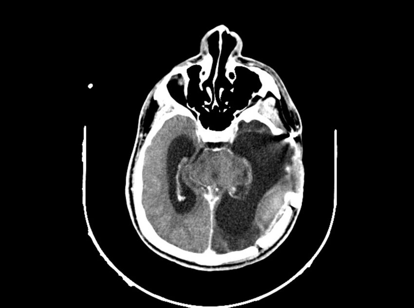 Brain injury by firearm projectile (Radiopaedia 82068-96088 B 113).jpg