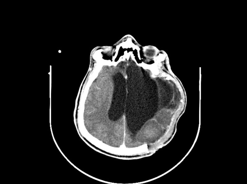 File:Brain injury by firearm projectile (Radiopaedia 82068-96088 B 142).jpg