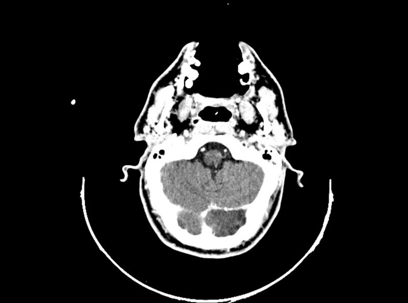 File:Brain injury by firearm projectile (Radiopaedia 82068-96088 B 70).jpg