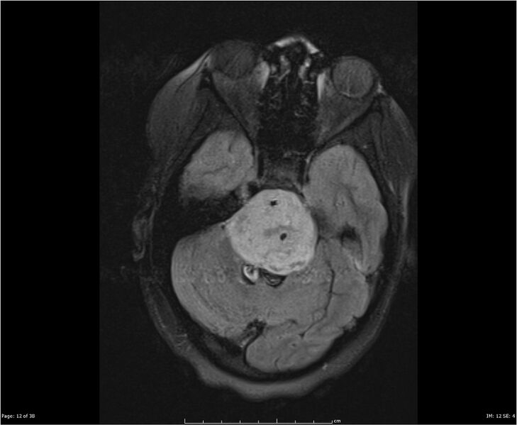 File:Brainstem glioma (Radiopaedia 21819-21775 Axial FLAIR 12).jpg