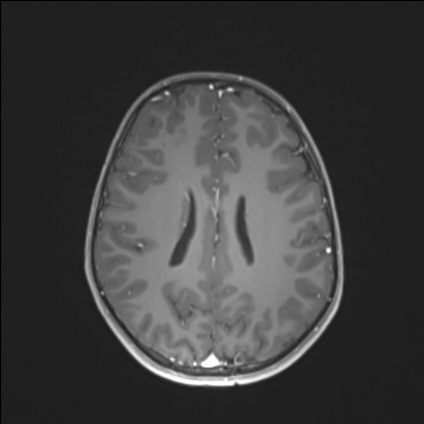 Brainstem glioma (Radiopaedia 70548-80674 Axial T1 C+ 103).jpg