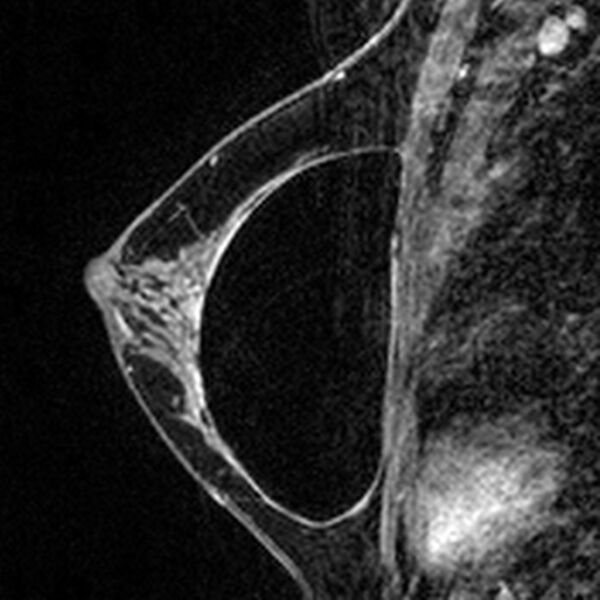 File:Breast implants - MRI (Radiopaedia 26864-27035 Sagittal T2 28).jpg