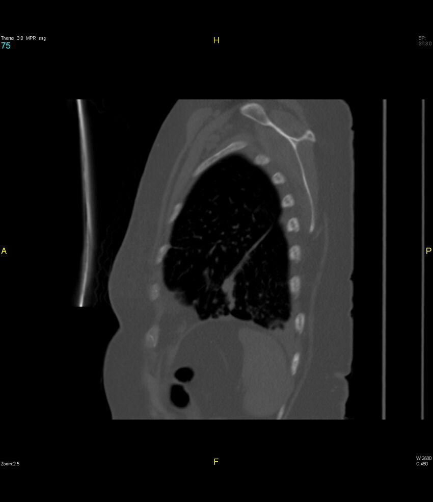 Breast primary with lung and bone metastases (Radiopaedia 40620-43228 Sagittal bone window 75).jpg