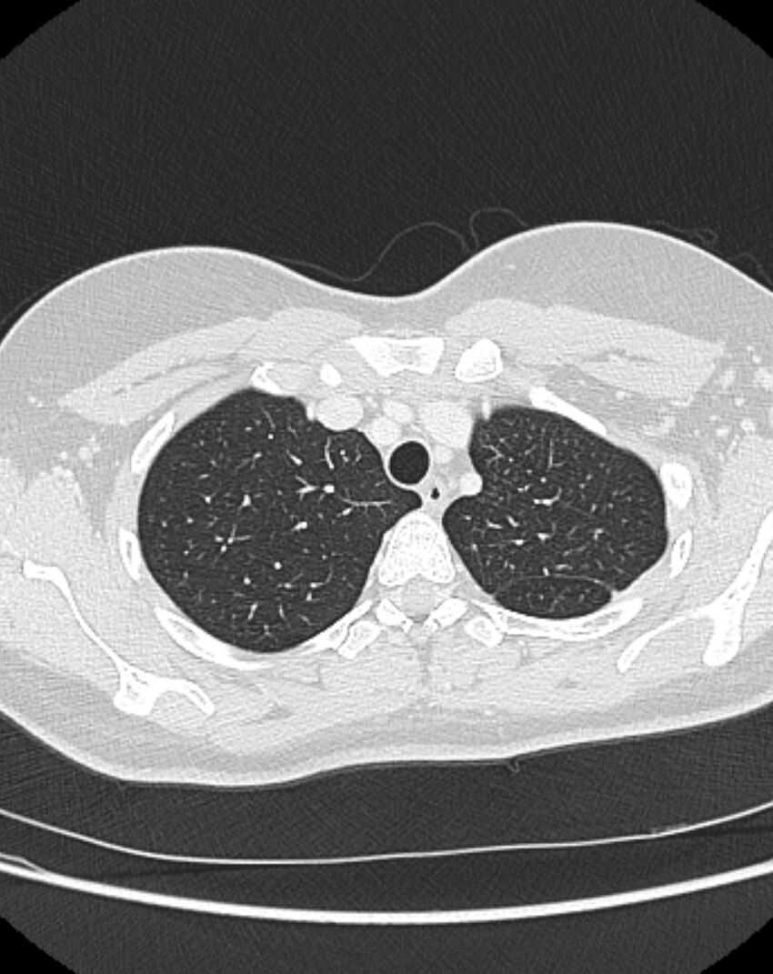Bronchial atresia (Radiopaedia 50007-55297 Axial lung window 16).jpg
