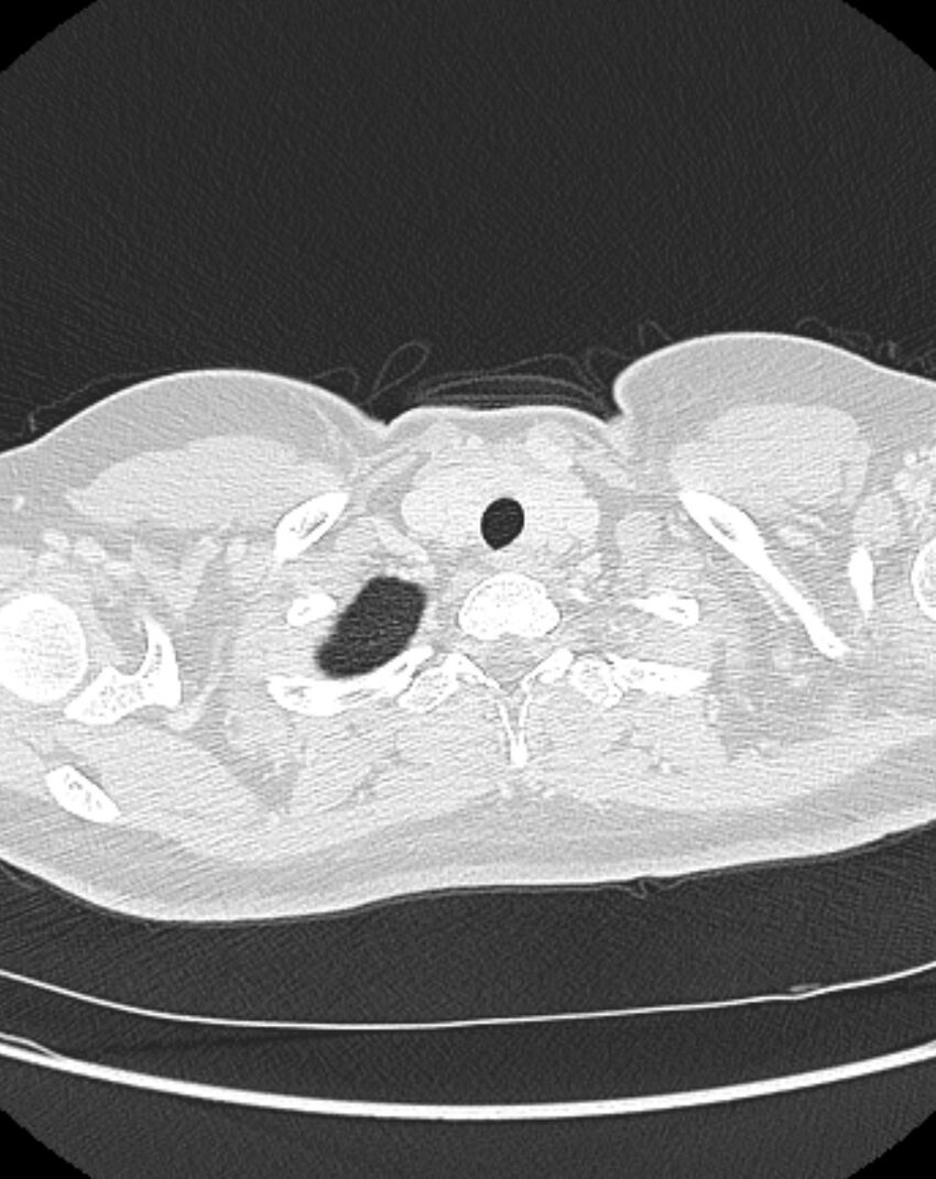 Bronchial atresia (Radiopaedia 50007-55297 Axial lung window 2).jpg