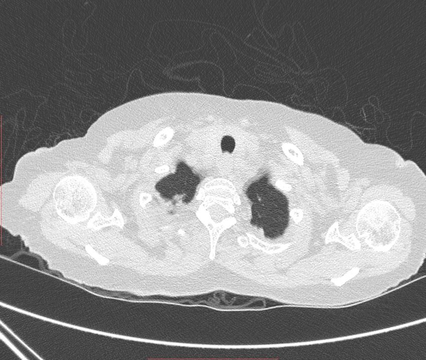 Bronchiectasis (Radiopaedia 72693-83293 Axial lung window 3).jpg