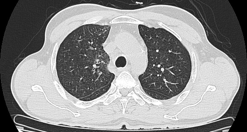 File:Bronchogenic carcinoma with superior vena cava syndrome (Radiopaedia 36497-38054 Axial lung window 31).jpg