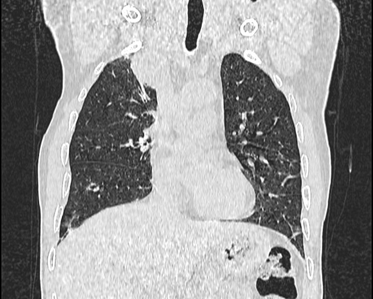 File:Bronchogenic carcinoma with superior vena cava syndrome (Radiopaedia 36497-38054 Coronal lung window 18).jpg