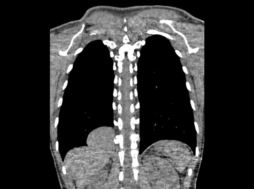 Bronchogenic cyst (Radiopaedia 80273-93615 D 109).jpg
