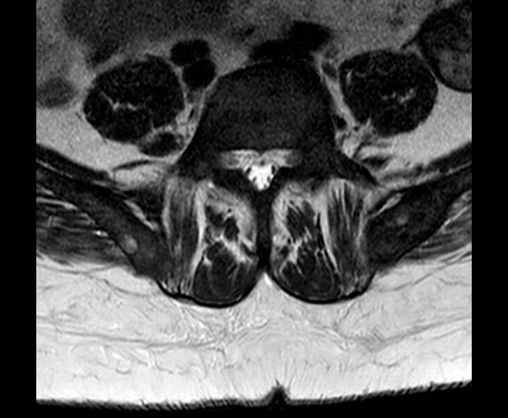 File:Brown tumors compressing the spinal cord (Radiopaedia 68442-78030 Axial T2 - lumbar 17).jpg