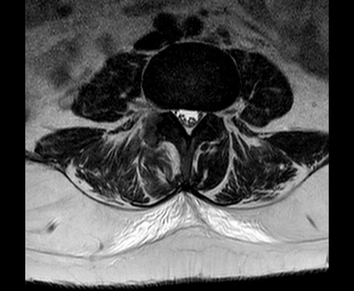 File:Brown tumors compressing the spinal cord (Radiopaedia 68442-78030 Axial T2 - lumbar 25).jpg