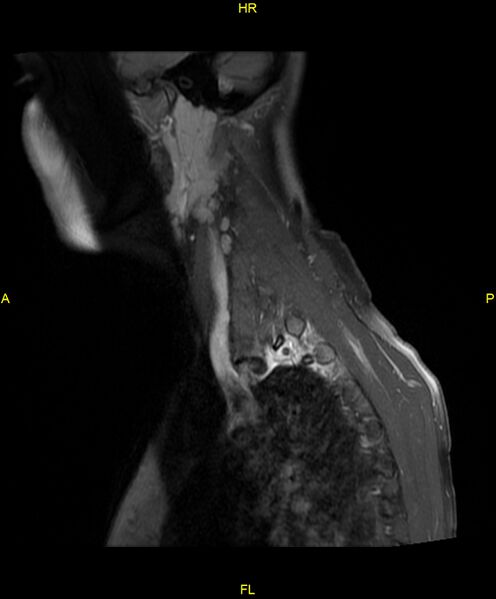 File:C5 nerve sheath tumor (Radiopaedia 85777-101596 F 3).jpg