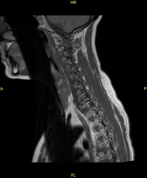 File:C5 nerve sheath tumor (Radiopaedia 85777-101596 Sagittal T1 13).jpg