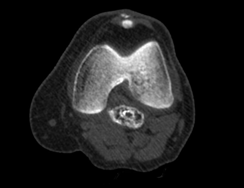 File:Calcified hematoma - popliteal fossa (Radiopaedia 63938-72763 Axial bone window 11).jpg