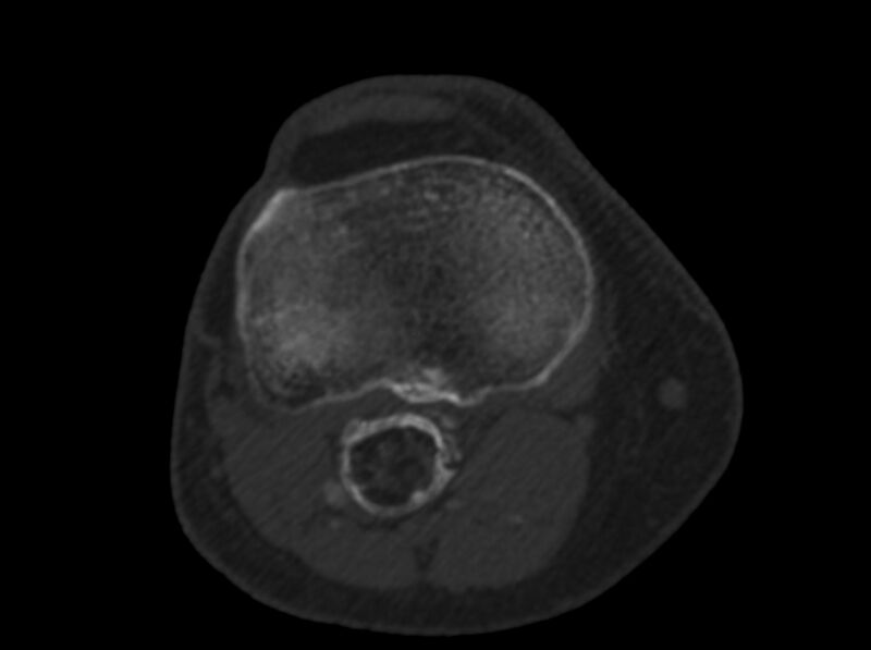 File:Calcified hematoma - popliteal fossa (Radiopaedia 63938-72763 C 44).jpg