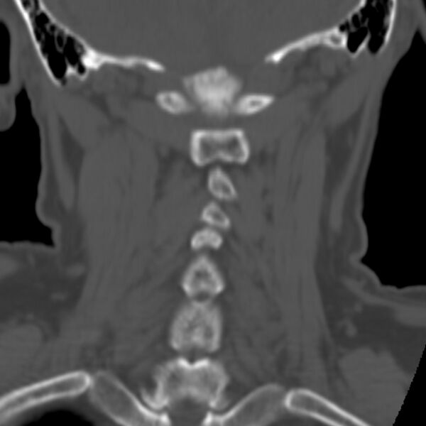 File:Calcified meningioma - cervical canal (Radiopaedia 70136-80171 Coronal bone window 26).jpg