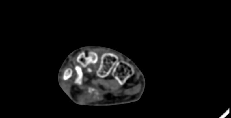 File:Calcifying aponeurotic fibroma (Radiopaedia 88423-105064 B 106).jpg