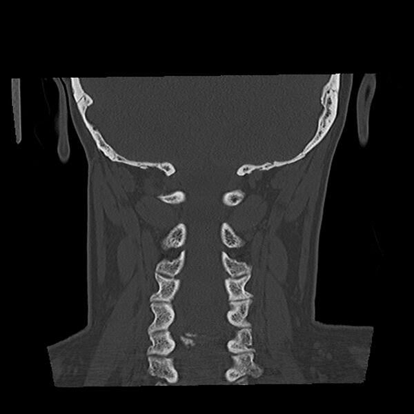 File:Canal up mastoidectomy (Radiopaedia 78108-90638 Coronal bone window 48).jpg