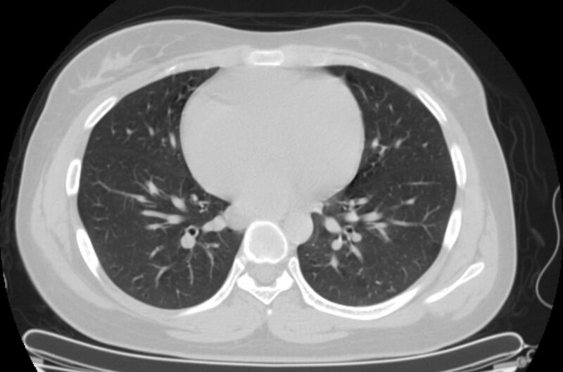 File:Cannonball metastases - uterine choriocarcinoma (Radiopaedia 70137-80173 Axial lung window 65).jpg