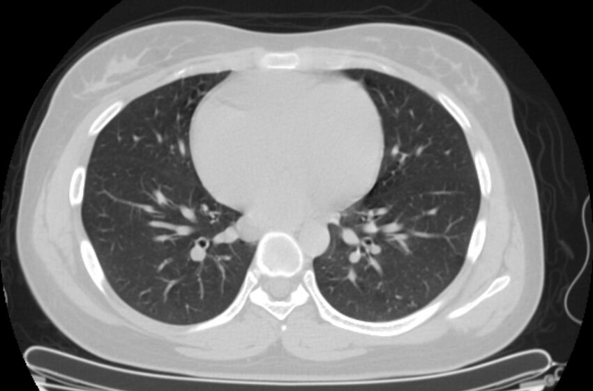 Cannonball metastases - uterine choriocarcinoma (Radiopaedia 70137-80173 Axial lung window 65).jpg