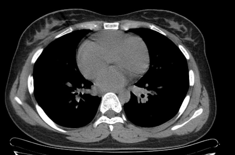 File:Cannonball metastases - uterine choriocarcinoma (Radiopaedia 70137-80173 Axial non-contrast 69).jpg