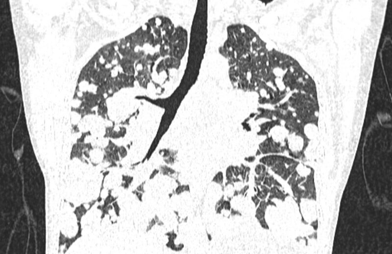 File:Cannonball metastases from breast cancer (Radiopaedia 91024-108569 Coronal lung window 80).jpg